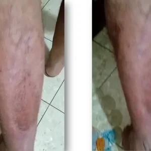 image14 post phage therapy